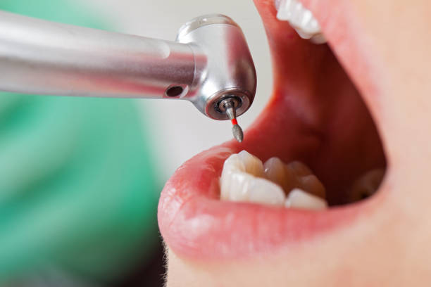 Best Broken or Chipped Tooth Repair in Mattituck, NY